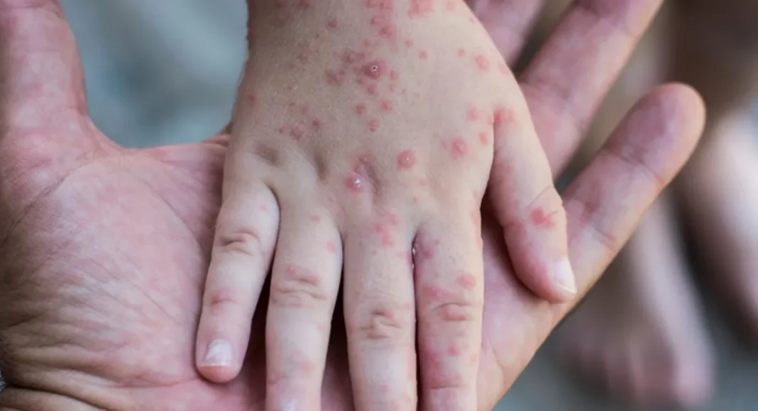 ¡Alerta en México! Emiten Aviso Epidemiológico por Sarampión