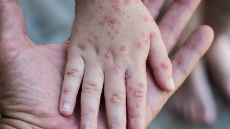 ¡Alerta en México! Emiten Aviso Epidemiológico por Sarampión