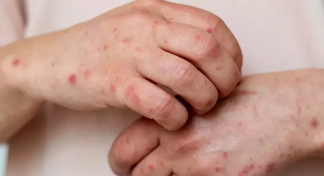 Mapimí concentra la mayoría de casos de sarampión en Durango