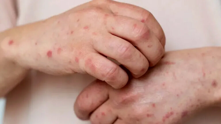 Mapimí concentra la mayoría de casos de sarampión en Durango