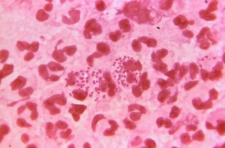 Europa alerta por aumento de gonorrea resistente a antibióticos
